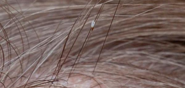 كيفية التخلص من القمل نهائياً