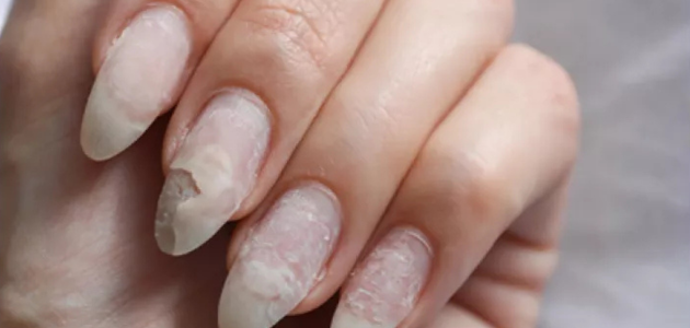 A set of important tips to prevent cracked nails مجموعة نصائح هامة للوقاية من تشقق الأظافر