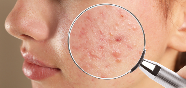 How to get rid of pimples quickly كيفية التخلص من البثور بسرعة
