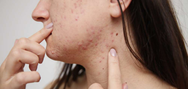 Natural mixtures to get rid of pimples quickly خلطات طبيعية للتخلص من البثور بسرعة