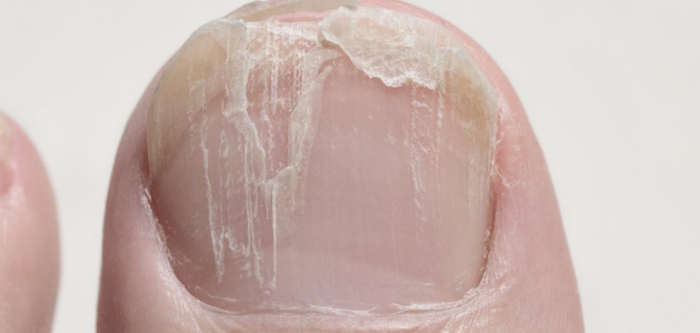 The best treatment for cracked nails أفضل علاج لتشقق الأظافر