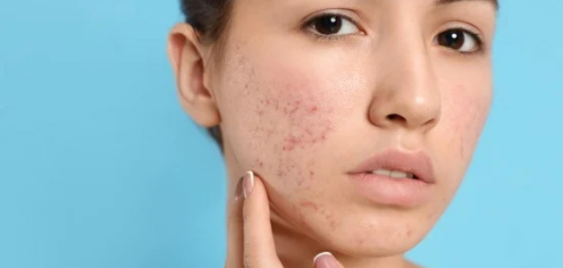 Tips to protect the skin from the appearance of pimples نصائح لحماية البشرة من ظهور البثور