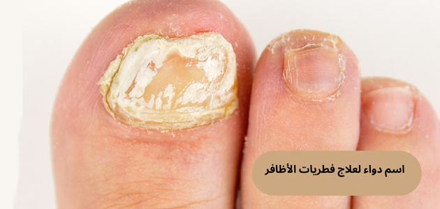اسم دواء لعلاج فطريات الأظافر