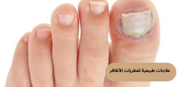 علاجات طبيعية لفطريات الأظافر