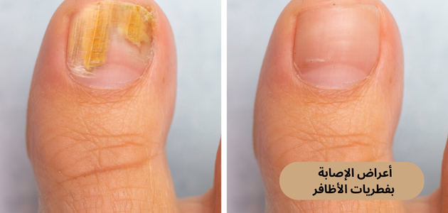 أعراض الإصابة بفطريات الأظافر