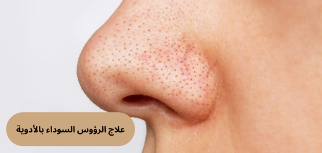 علاج الرؤوس السوداء بالأدوية