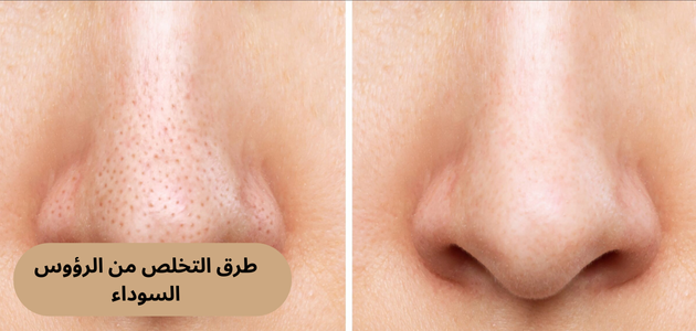 طرق التخلص من الرؤوس السوداء