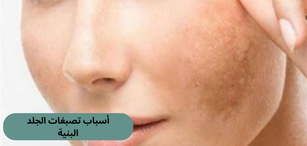 أسباب تصبغات الجلد البنية