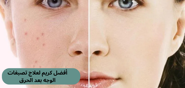 أفضل كريم لعلاج تصبغات الوجه بعد الحرق