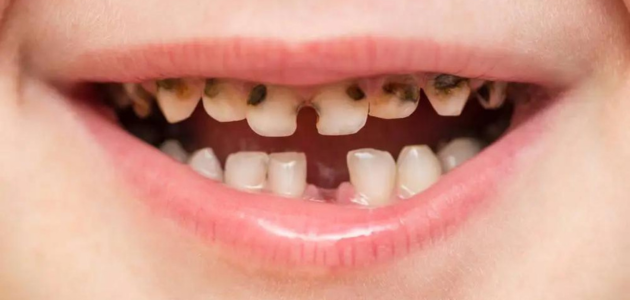 أسباب تسوس الأسنان