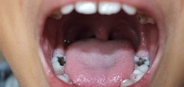 أعراض تسوس الأسنان 