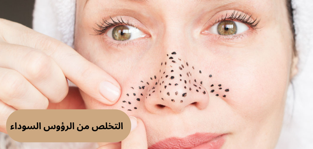التخلص من الرؤوس السوداء