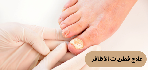 الحل النهائي لعلاج فطريات الأظافر وكيفية الوقاية منها