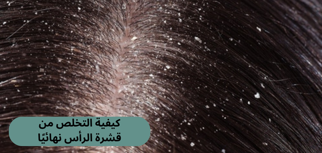 كيفية التخلص من قشرة الرأس نهائيًا